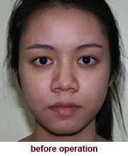 plastic_surgery_augmentation_rhinoplasty